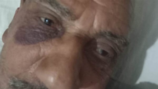 بسبب قشر الموز..