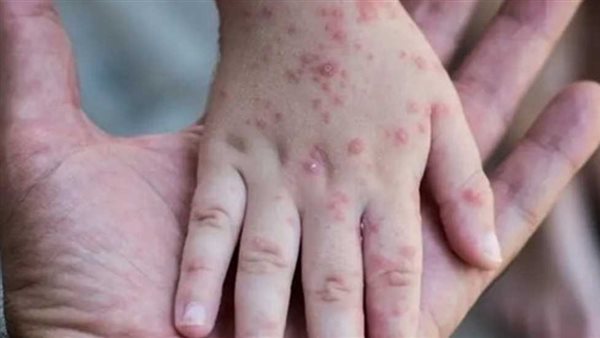  فيروس جدري القرود