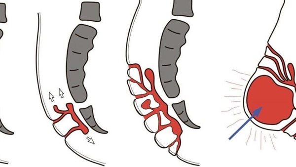 الناسور العصعي