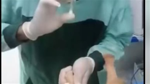 تركيب كانيولا في