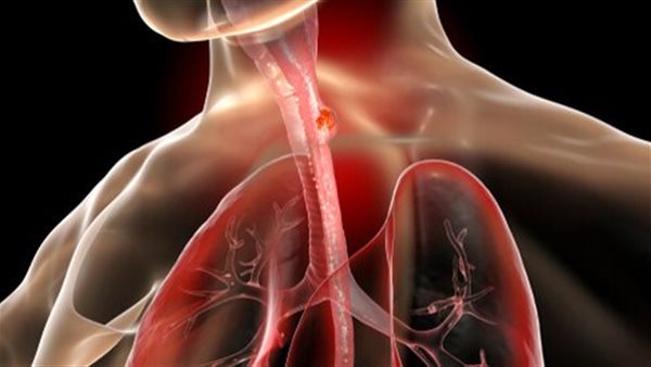 مرض السرطان 