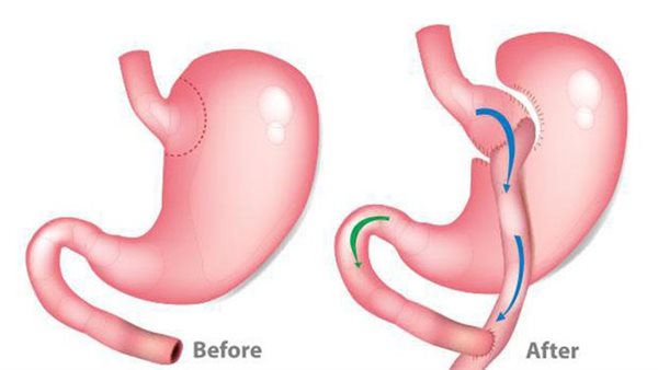 عملية تحويل مسار