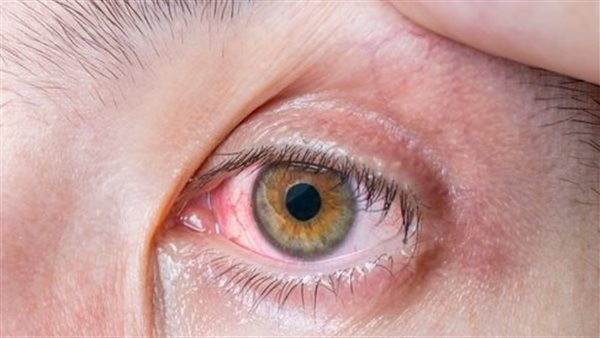 الرمد الربيعي