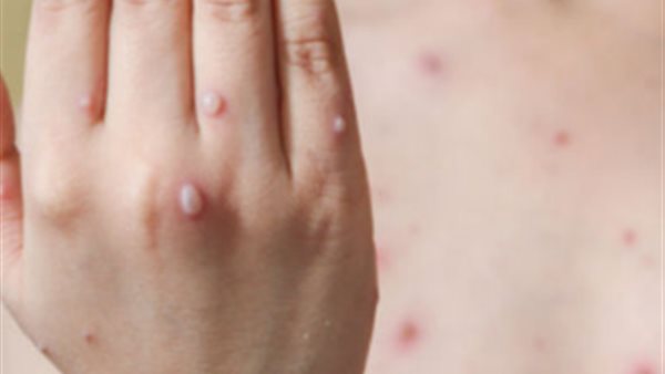 الجديري المائي