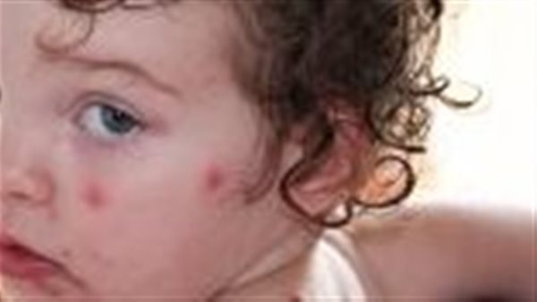 الجدري المائي 