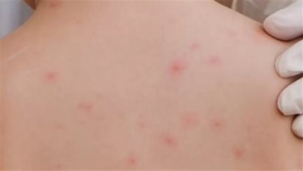 جدري المائي 