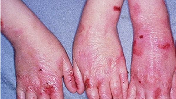 مرض الجلد الفقاعي