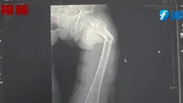 الأشعة السينية 