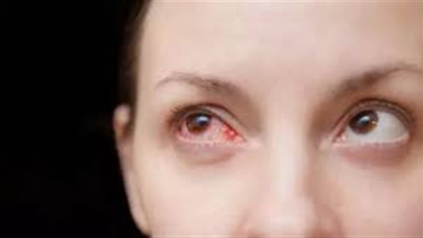 أمراض العيون