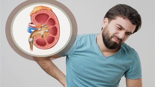 تأثير الملح على الكلى