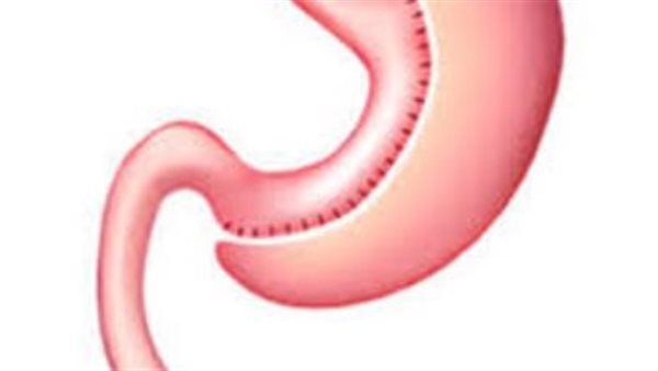 عملية تكميم المعدة