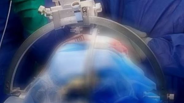 وسواس قهري مستعصي