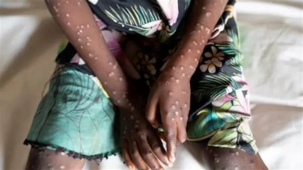 جدري القرود