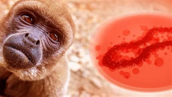 جدرى القرود 