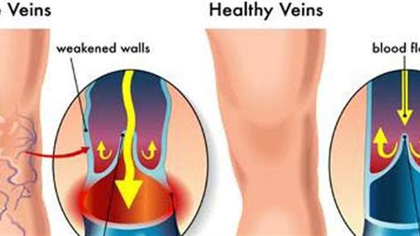 علاج الدوالي 