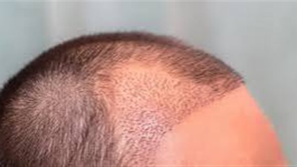 زراعة الشعر 