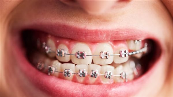 تقويم الأسنان 