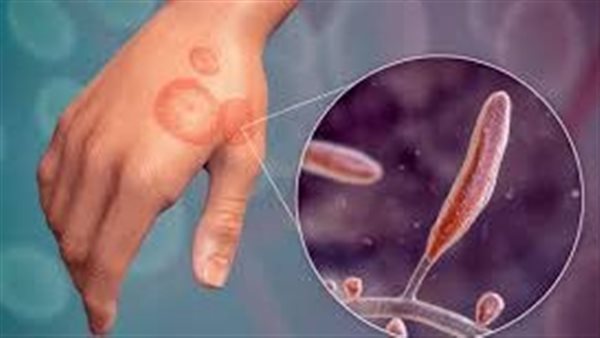 العدوى الفطرية 