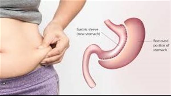 تكميم المعدة 