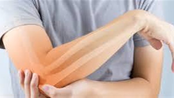 هشاشة العظام 