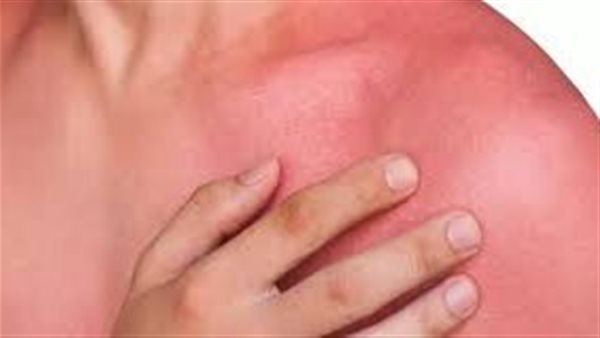 احمرار الجلد