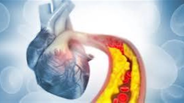 انسداد الشرايين