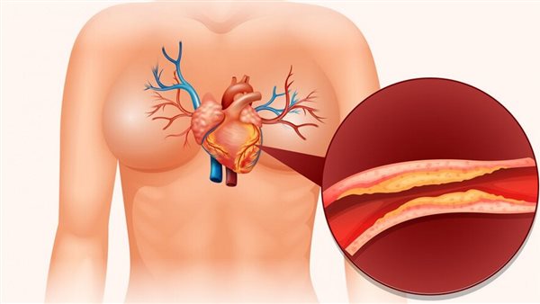 التهابات الشرايين