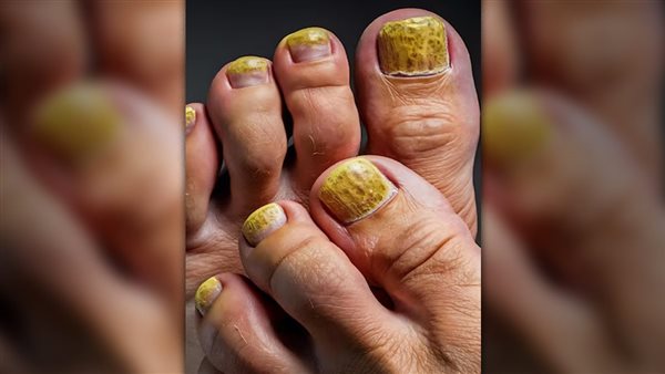 متلازمة الاظافر الصفراء