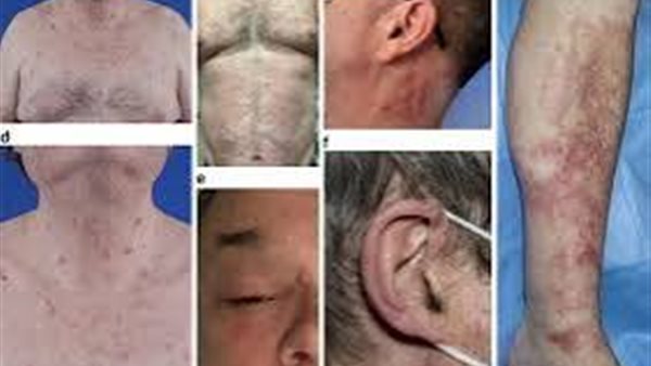 متلازمة فيكساس