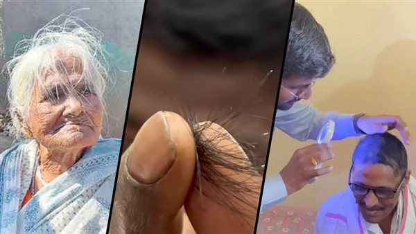 فيروس الصلع 