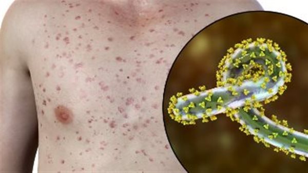 فيروس ماربورغ