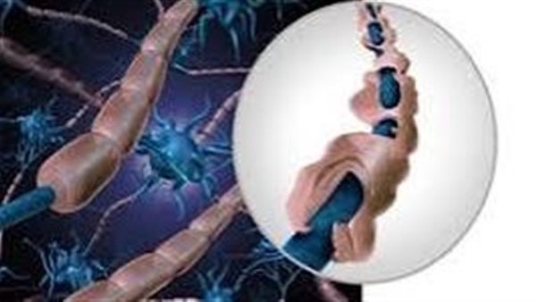 متلازمة غيلان باريه