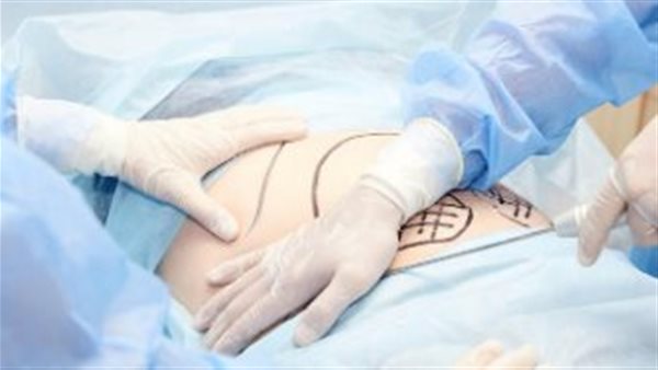 عملية شفط دهون