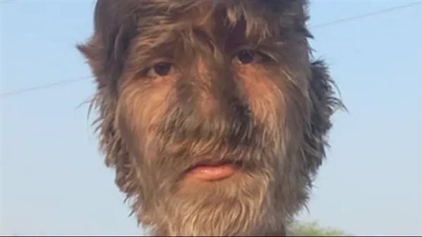 متلازمة الذئب