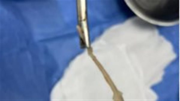 استخراج عظمة بطة