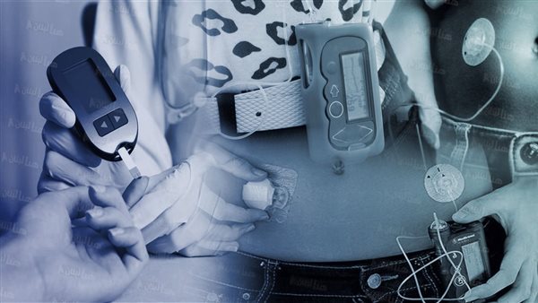 البنكرياس الاصطناعي