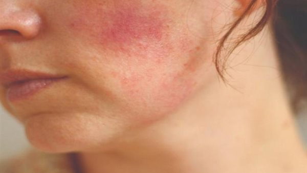 التهابات البشرة