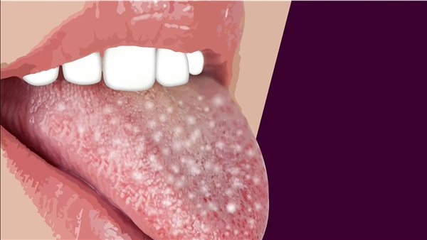 سرطان اللسان.. أرشيفية