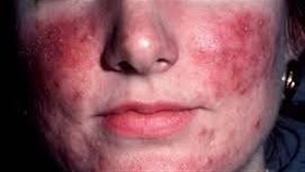 مرض الوردية.. أرشيفية