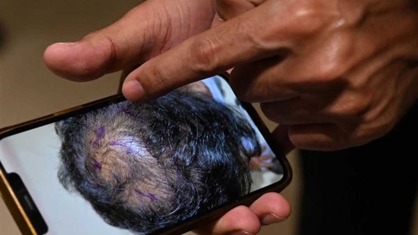 نتائج العلاج الجديد